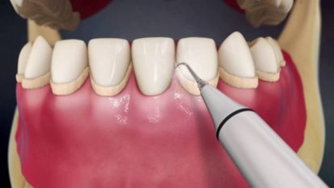 teeth cleanig