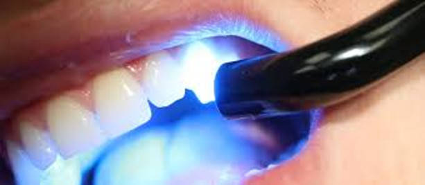 composite filling